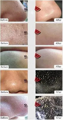 Picture of AICHUN BEAUTY Whitening Complex Black Mask Remove Blackhead Deep Cleansing Pilaten Blackhead Remover Purifying Peel Face Mask 120ml