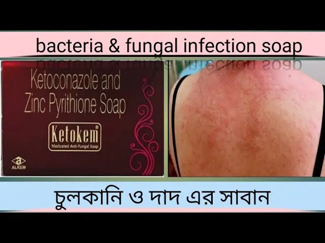 Picture of Ketokem Medicated Anti-Fungal Soap(Indian) - 75gm