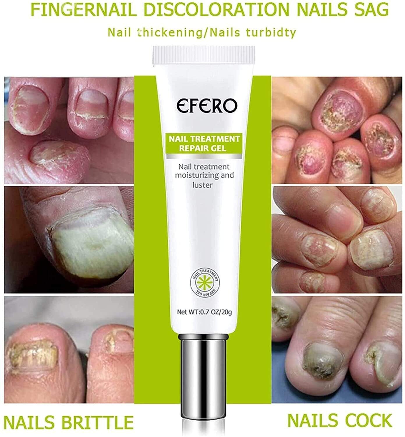 Picture of Efero Nail Repair Treatment Gel Fungus Cream-20gm