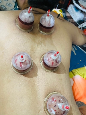 Picture of Hijama Cupping Set Vacuum – 12pcs Dry Massage Cupping Therapy Set for Hijama Treatment