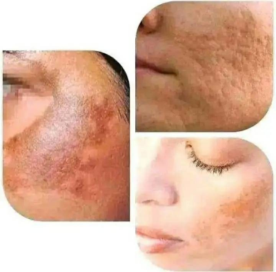 Picture of P Vita Melasma Cream 10 Gram (Thailand)