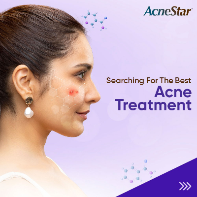 Picture of 50 gm Mankind Acne Star face wash Indian product used for male female