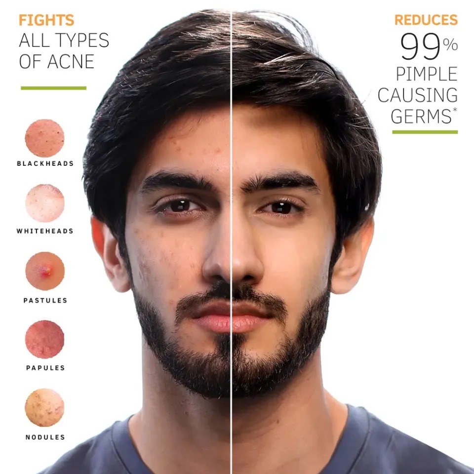 Picture of 50 gm Mankind Acne Star face wash Indian product used for male female