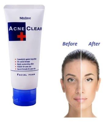 Picture of International Thailand product Acne Clear Plus Facial Foam used For male/female 85 Gm