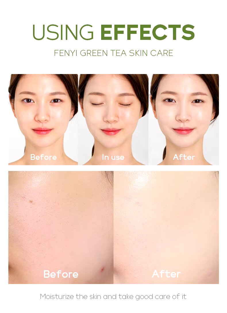 Picture of Fenyi Tea Tree Acne Removal Face Toner Repairing Soothing Tighten Pores - 100ml