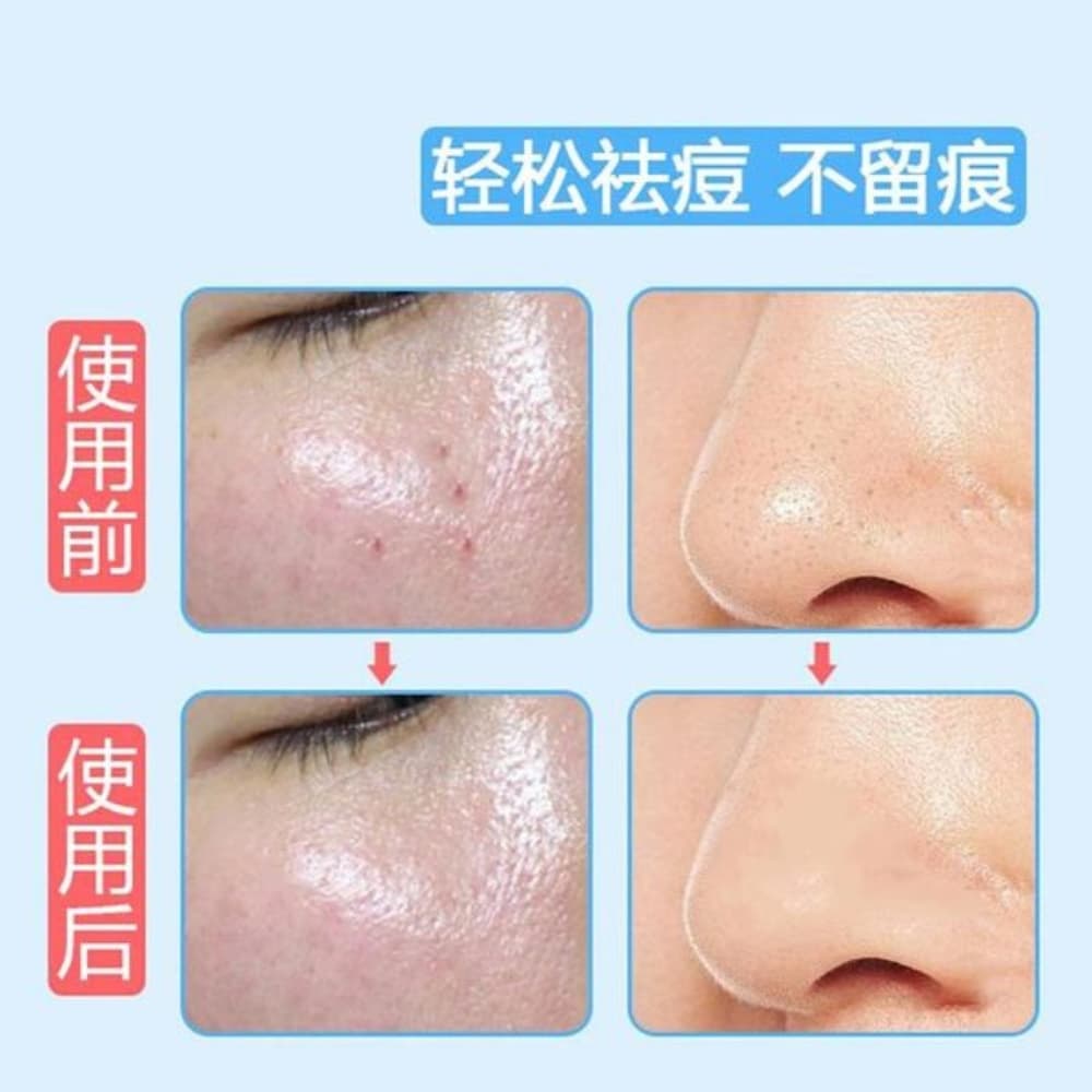 Picture of Stainless Steel Double-Head Bron Stick Acne Needle Blackhead Remover Tool Pimple Spot Extractor