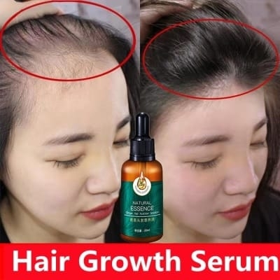 Picture of 100% Natural Ginger Hair Serum Hair Grower Fast Long Hair Treatment Minoxidil Hair Grower Castor Oil For Essence Preventing Baldness Consolidate Hair Loss Treatment repairs the hair improves hair loss hair growth serum 10 x faster