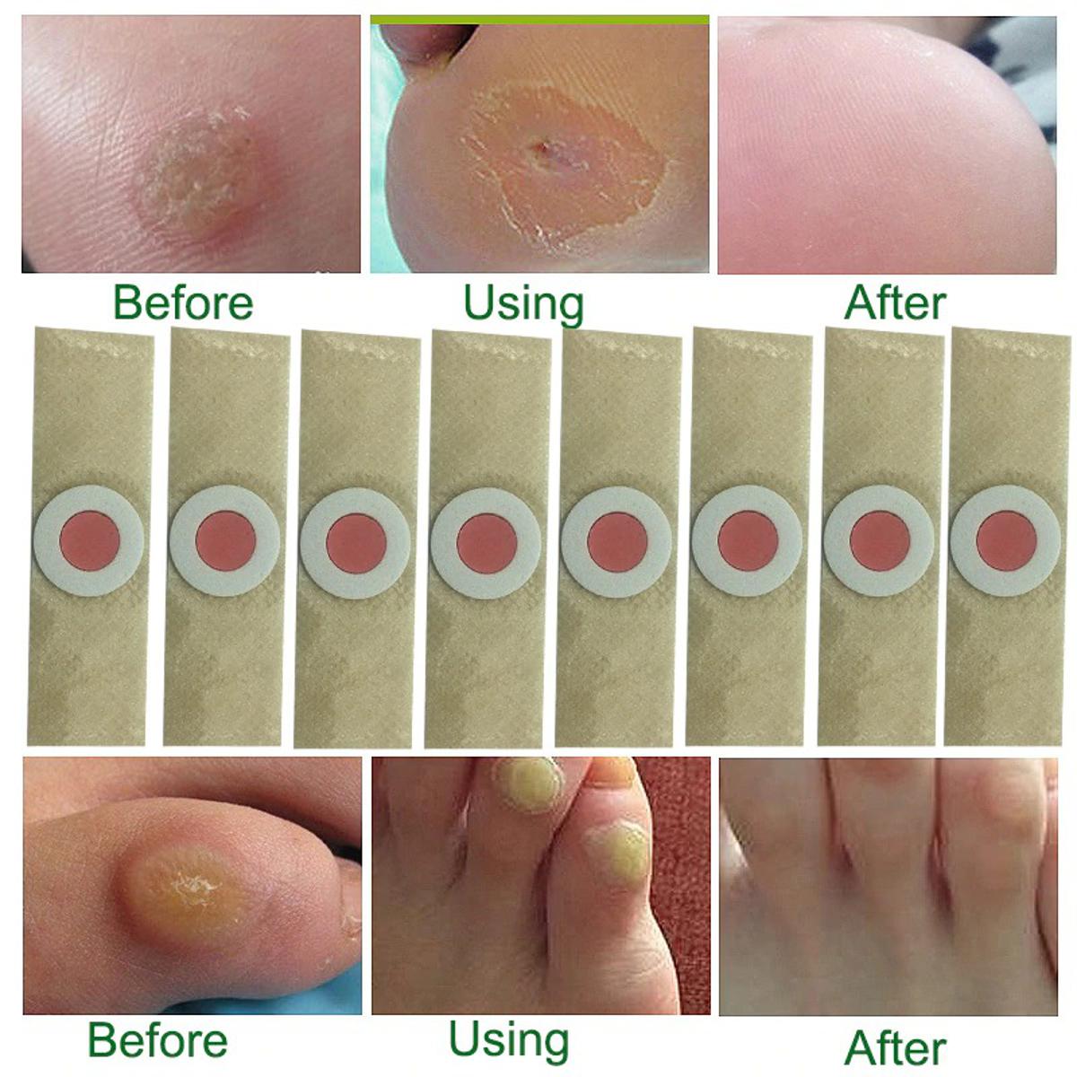 Picture of Plasters Foot Corn Removal 6pcs - Fresh