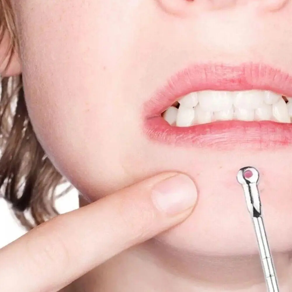 Picture of 3pcs Silver Blackhead Comedone Acne Blemish Extractor Remover Cosmetic Tool Stainless Needles Remove Tool