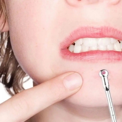 Picture of 3pcs Silver Blackhead Comedone Acne Blemish Extractor Remover Cosmetic Tool Stainless Needles Remove Tool