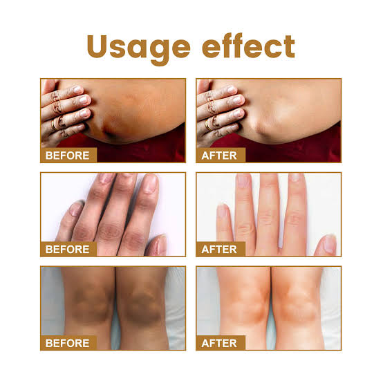Picture of JAYSUING Therapy Drops-Reduce Dark Spot & Lightens Skin Discoloration 10ML