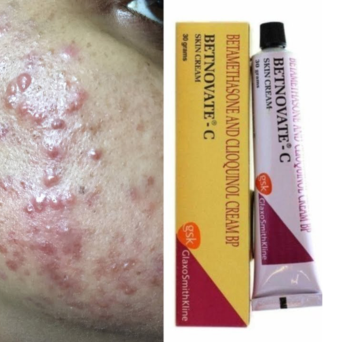 Picture of Betnovate C Skin Cream -30gm