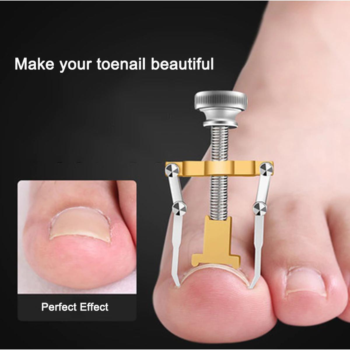 Picture of Ingrown Toenail Toe Fixer Recover Correction Device Pedicure Foot Nail Care Tool Straightening Clip Brace Corrector Easy To Use - Pedicure Set - Gold