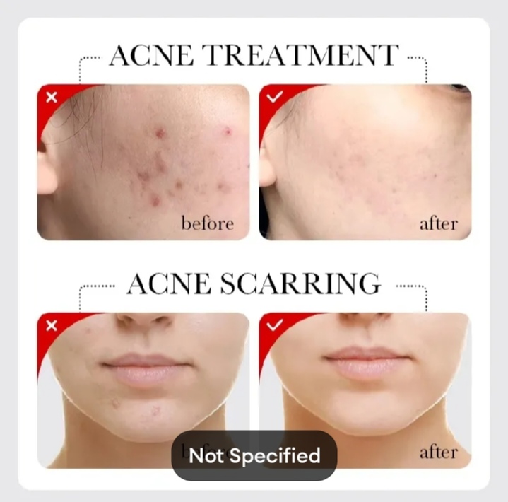 Picture of SADOER Fruit Acid AHA+BHA Acne Repair Serum-30ml - 