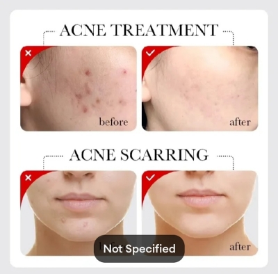 Picture of SADOER Fruit Acid AHA+BHA Acne Repair Serum-30ml - 