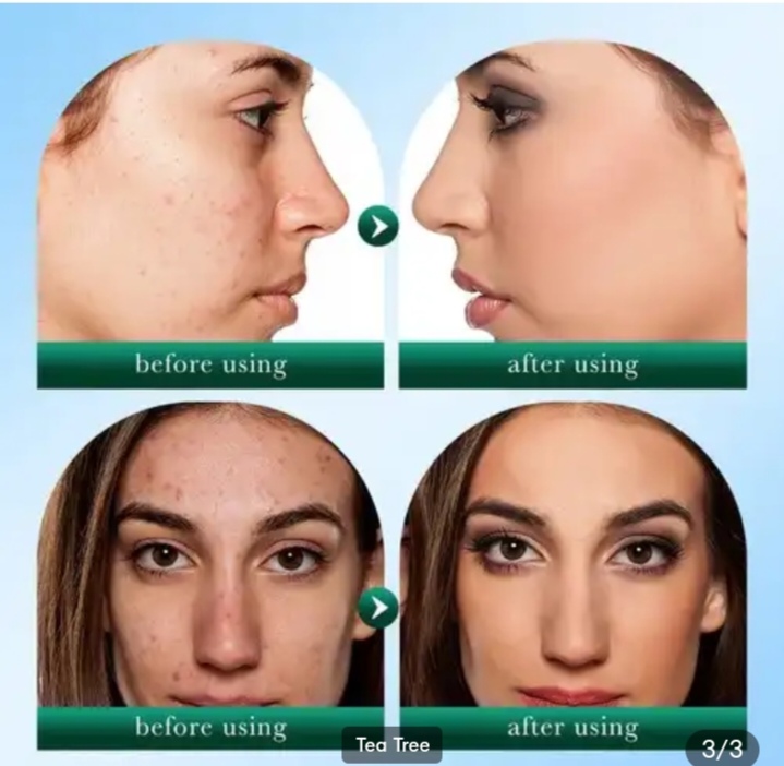 Picture of SADOER Tea Tee Pimple & Acnes Reduce Oil Control Cleanser- 100g Face Wash - 