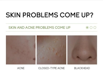 Picture of Fenyi 5% Mandelic Acid Anti Acne Serum- 17ml - 