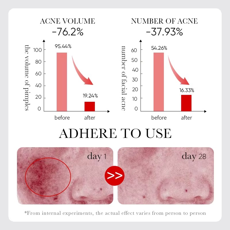 Picture of SADOER Fruit Acid AHA+BHA Acne Repair Serum- 30ml - 