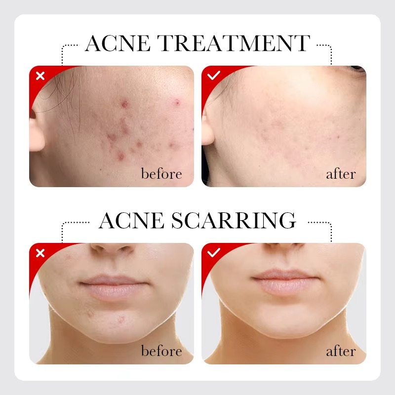 Picture of SADOER Fruit Acid AHA+BHA Acne Repair Serum- 30ml - 