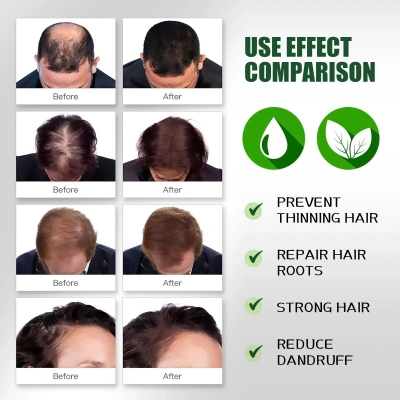 Picture of Rosemary Hair Growth Oil Ginger Anti Hair Loss Products Boost Hair Growing Serum Prevent Dry Frizz Damaged Scalp Repair Care