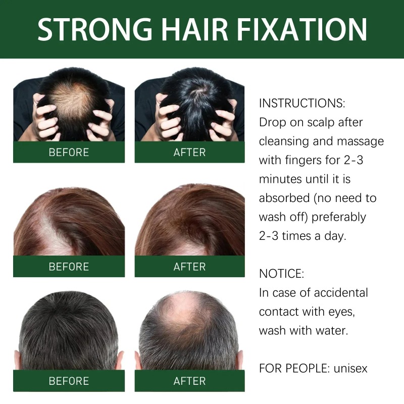 Picture of Rosemary Hair Growth Oil Ginger Anti Hair Loss Products Boost Hair Growing Serum Prevent Dry Frizz Damaged Scalp Repair Care