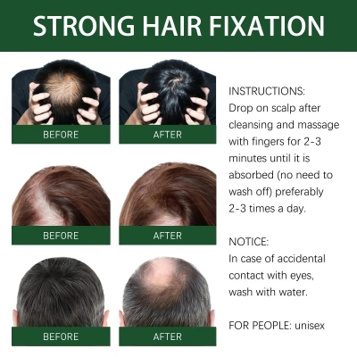 Picture of Rosemary Hair Growth Oil Ginger Anti Hair Loss Products Boost Hair Growing Serum Prevent Dry Frizz Damaged Scalp Repair Care