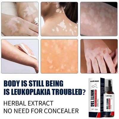 Picture of South Moon White Tag Treatment Spray Herbal Antibacterial Vitiligo Treatment Serum Leukoplakia Disease Pigment Melanin Repair Body Face Care（30ml）