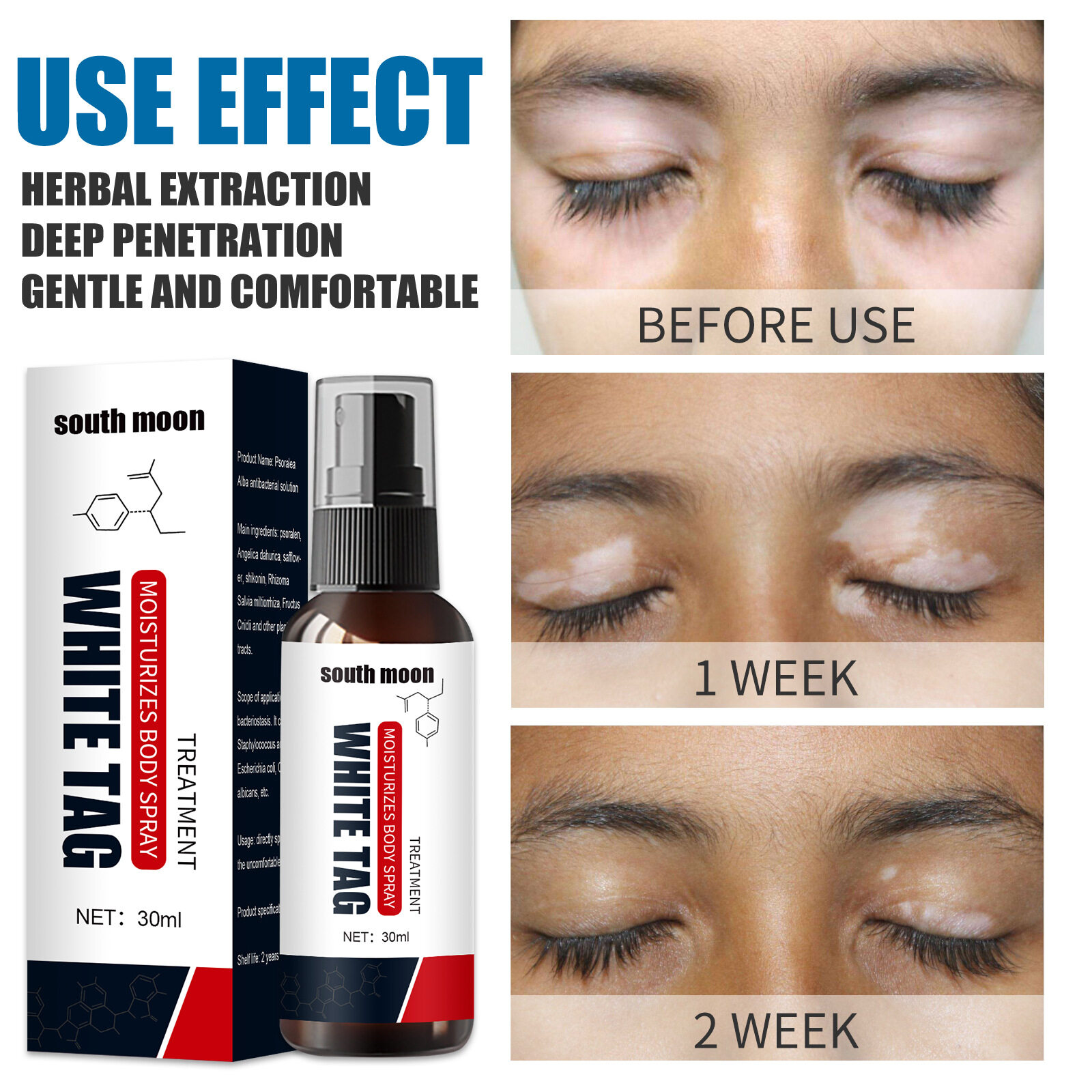 Picture of South Moon White Tag Treatment Spray Herbal Antibacterial Vitiligo Treatment Serum Leukoplakia Disease Pigment Melanin Repair Body Face Care（30ml）
