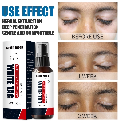 Picture of South Moon White Tag Treatment Spray Herbal Antibacterial Vitiligo Treatment Serum Leukoplakia Disease Pigment Melanin Repair Body Face Care（30ml）