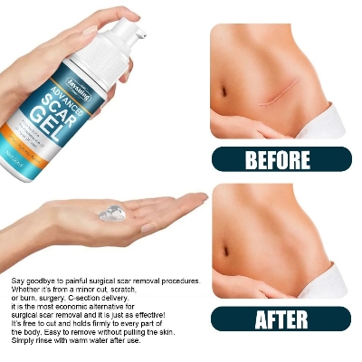 Picture of Jaysuing Advanced 50ml Scar Removal Gel - Effective Stretch Mark, Acnes Spots, Burns and Surgical Scars Treatment Cream Scar Gel No Side Effect