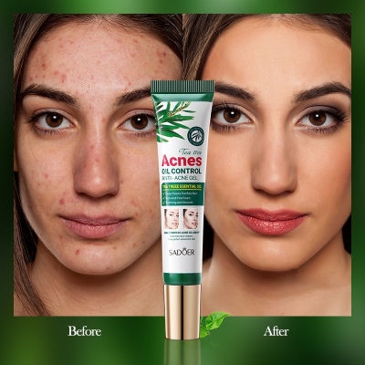 Picture of SADOER Tea Tree Acne Oil Control Face Gel Anti-Acne Hydrating Moisturizing Gel 20g