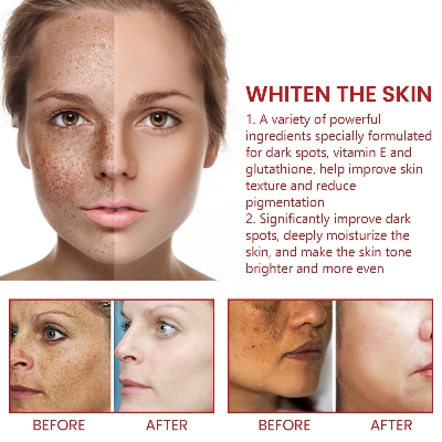 Picture of Dark Spot Remover For Face & Body Age Spot Brown Spot Sun Spot & Freckle Remover for Face Hands and Other Body Areas for Both Women and Men