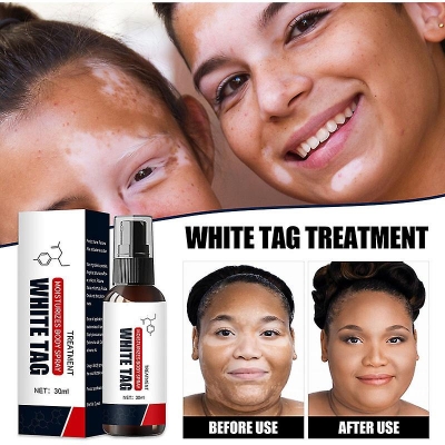 Picture of South Moon White Tag Treatment Spray Herbal Antibacterial Vitiligo Treatment Serum Leukoplakia Disease Pigment Melanin Repair Body Face Care（30ml）