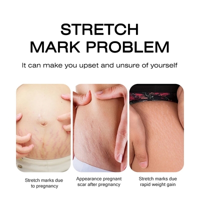 Picture of MOIKA Antipregnancy Wrinkle & Stretch Mark Removal Cream 50Gm