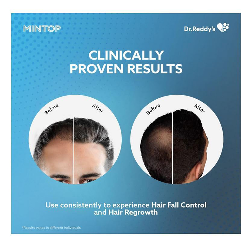 Picture of Dr.Reddy Minoxidil Topical Solution Mintop 5% - 60 ML