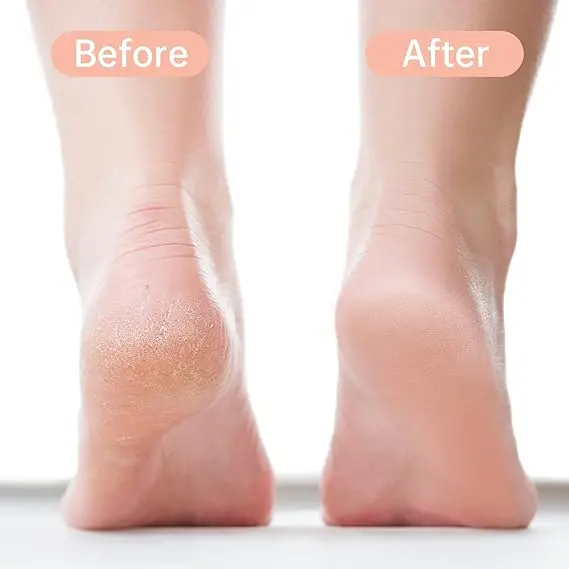 Picture of Foot Files Callus Remover Stainless Steel Foot Rasp, Foot Scrubber, Foot Scraper Pedicure Foot File Tools for Dead Skin - Fresh