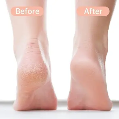 Picture of Foot Files Callus Remover Stainless Steel Foot Rasp, Foot Scrubber, Foot Scraper Pedicure Foot File Tools for Dead Skin - Fresh