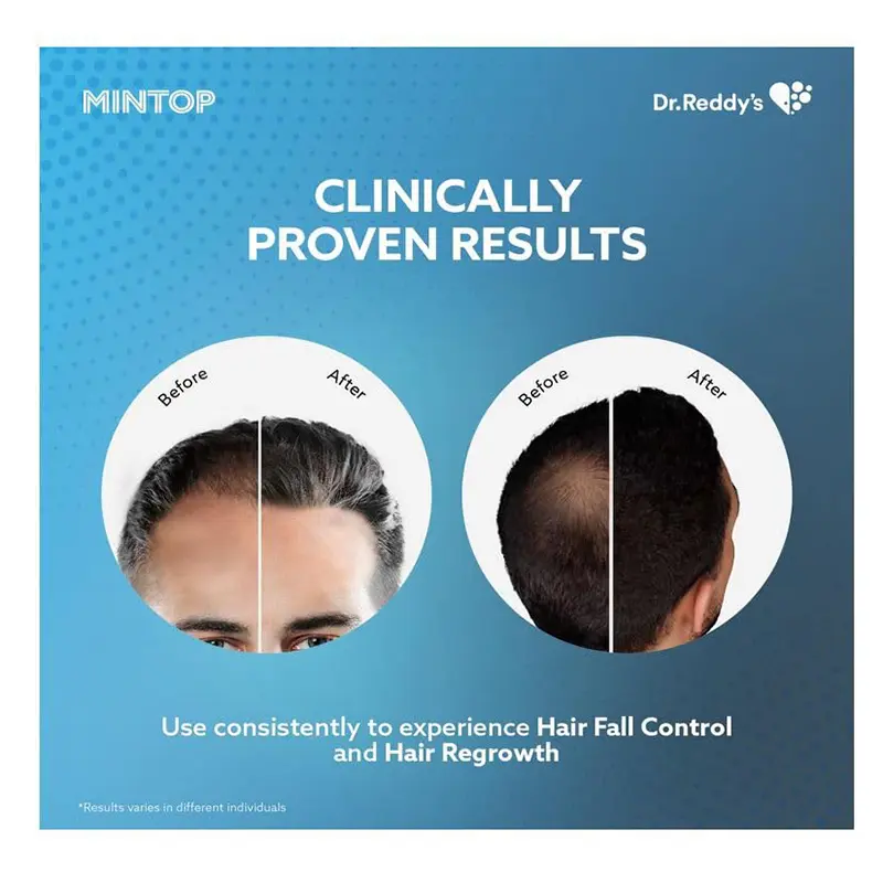 Picture of Dr.Reddy Minoxidil Topical Solution Mintop 5% - 60 ML