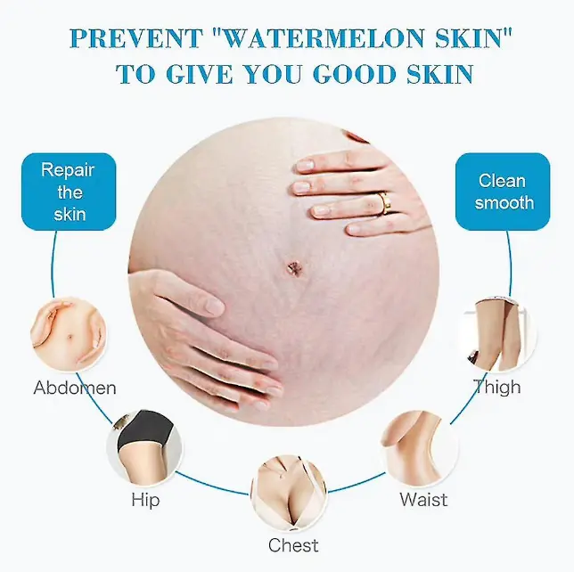 Picture of Aichun Beauty Anti Stretch Mark Cream Intensive Skin Treatment for Improvement & Elimination 60g