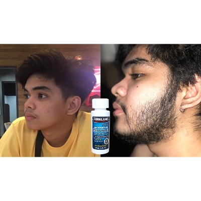 Picture of Kirkland Minoxidil 5% 1 Bottle + ZGTS Derma Roller 0.5mm 192 Titanium Needles - Hair,Beard Regrowth Combo Pack Ratings 1 