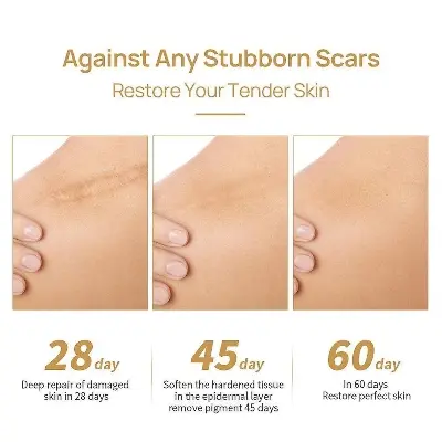 Picture of LanBeNa - TCM Acne Scar Removal Cream Skin Repair Face Cream for Burns Cuts Operation Stretch Mark Remover Acne Scar Treatment-30gm