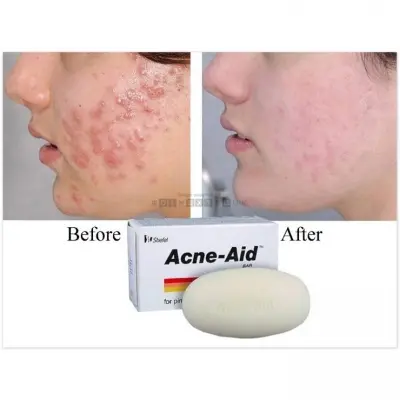 Picture of Acne Aid Soap Bar for Acne and Oily Skin - 100gm
