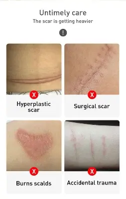 Picture of TCM -scar and acne mark removal gel ointment-30gm