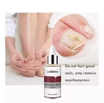 Picture of Lanbena Nail Fungal Treatment Remove Paronychia Onychomycosis Toe Nail Repairing,Treatment Toe Nail Repair Essence Nail Solution-15Ml