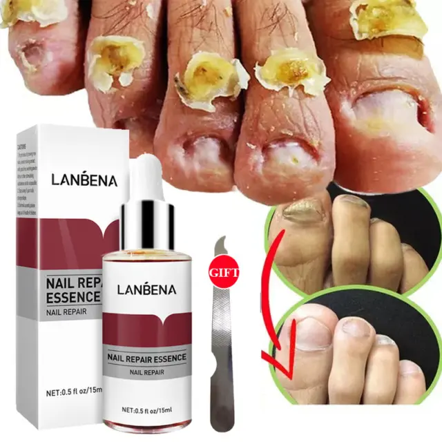 Picture of Lanbena Nail Fungal Treatment Remove Paronychia Onychomycosis Toe Nail Repairing,Treatment Toe Nail Repair Essence Nail Solution-15Ml