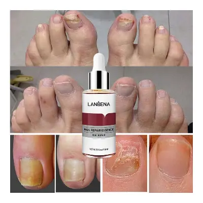 Picture of Lanbena Nail Fungal Treatment Remove Paronychia Onychomycosis Toe Nail Repairing,Treatment Toe Nail Repair Essence Nail Solution-15Ml