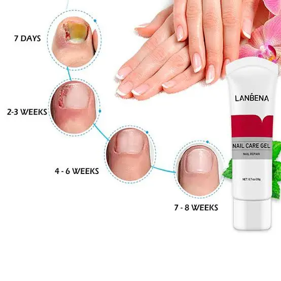Picture of LANBENA Nail Fungus Removal cream Treatment Onychomycosis Paronychia Anti Infection Feet Toe Nail Care Gel Fungal Nail Product-20GM