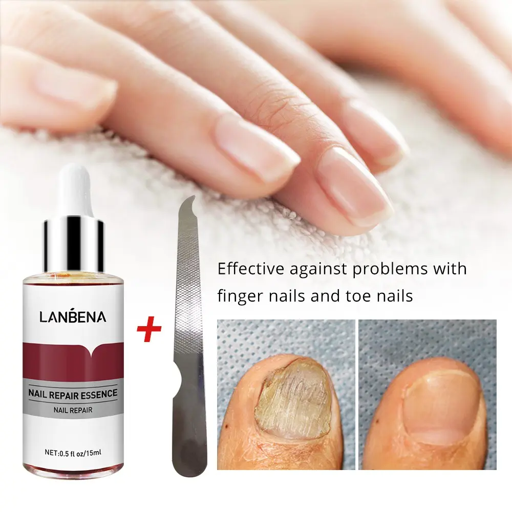 Picture of LANBENA Nail Repair Essence Serum Fungal Nail Treatment Remove Onychomycosis Toe Nourishing Brighten Hand Foot Skin Care 12ml