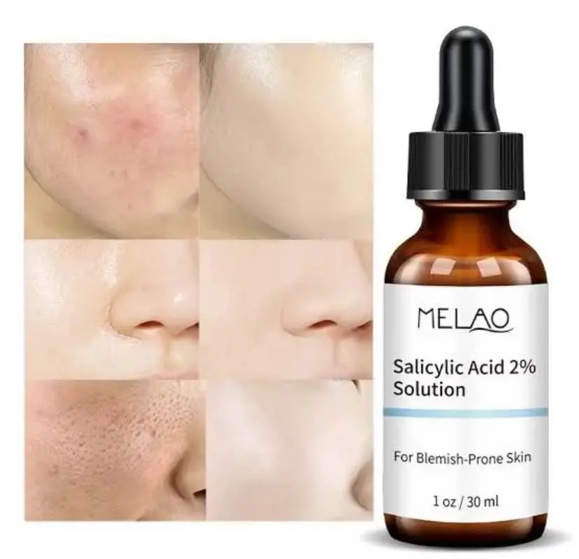 Picture of Melao Salicylic Acid 2% Solution – 30 ml