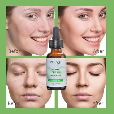 Picture of MELAO Natural Tea Tree Liquid Face Acne Essence Oil Control Serum -30ML
